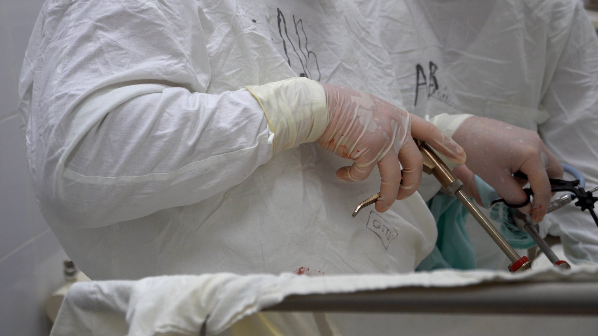 30-килограммовую опухоль яичника удалили у россиянки