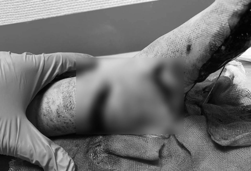 Юный россиянин чуть не лишился ноги во время уборки снега