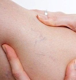Эффективные методы борьбы с сосудистыми звездочками на ногах